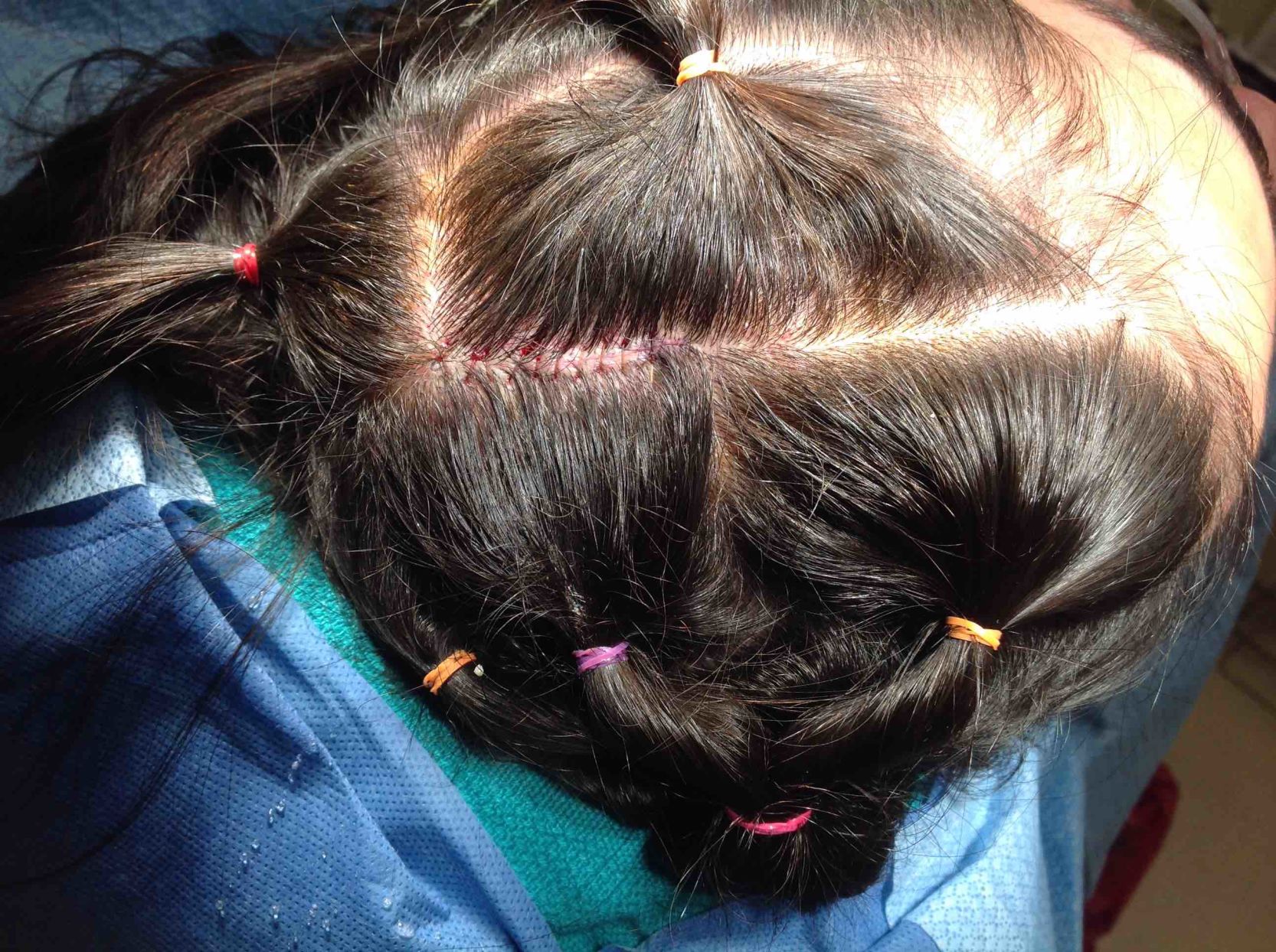 Key Cosmetic Concerns - Teen Bald Spots